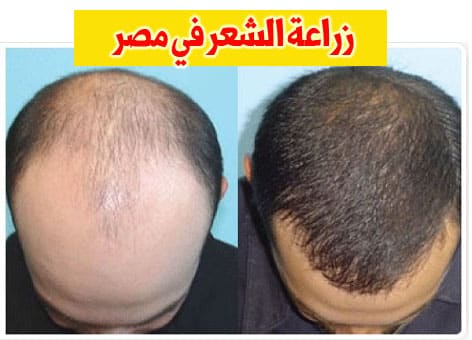تكلفة زراعة الشعر في مصر