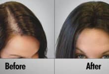 زراعة الشعر للنساء