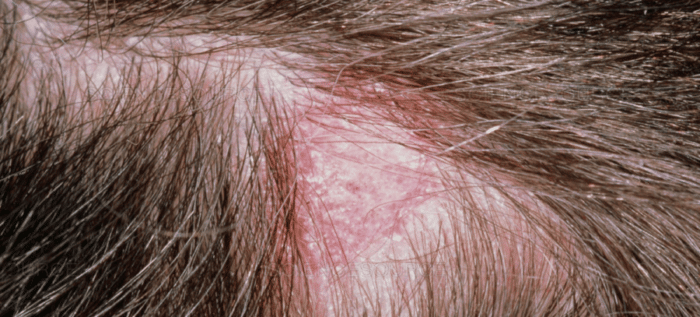 التهاب بصيلات الشعر أعراض المرض ومضاعفاته وكيفية علاجه هيرجرو