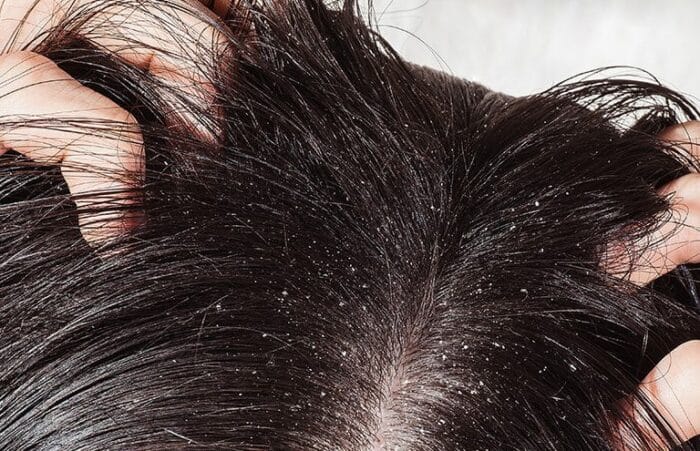 علاج القشرة في الشعر
